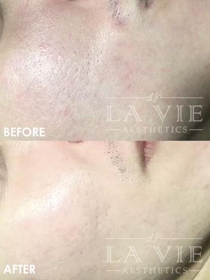 ="MRF MRF (RF Microneedling) Promotion